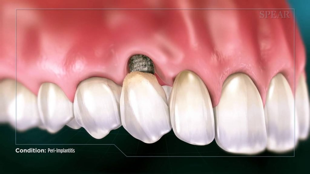 What Is Peri-implantitis? - Hunter Family Dental